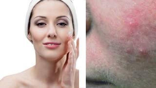 Treating Rosacea Dr Benjamin Barankin [upl. by Dabney493]