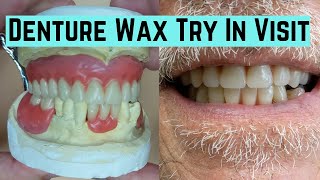 Denture Wax Try in visit [upl. by Aihsenrad282]