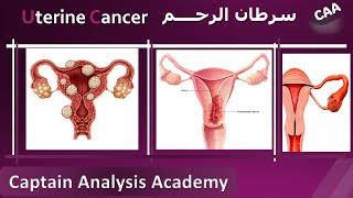 E4 Understanding Endometrial Cancer Uterine cancer سرطان الرحم اسبابة وطرق تشخيصة و علاجه [upl. by Avie]