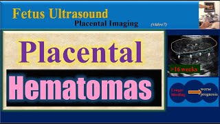 Fetus Ultrasound Placental Hematomas [upl. by Assirralc]