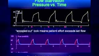 Mechanical Ventilation Waveform Analysis [upl. by Heringer]