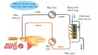 Lưu ý khi chạy thận nhân tạo để lọc máu  VTC [upl. by Thayne]