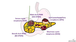 Cystic Neoplasms of Pancreas [upl. by Erreit360]