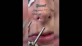 Laser spider veins removal nose beforeafter spiderveins lasernoseveins [upl. by Beckman]