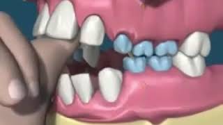 Teeth misalignment due to thumb sucking [upl. by Dorelle]