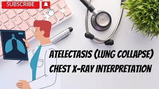 Chest X Ray Interpretation  5 Lung Collapse Atelectasis [upl. by Niobe]