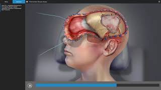 Traumatic Brain Injury  Brain Surgery Animation [upl. by Anaitsirc154]