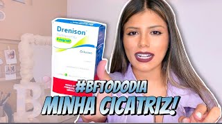 MINHA CICATRIZ DEU QUELOIDE FITA DRENISON VEDA3 [upl. by Chaworth]