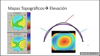 Pentacam I Dr Daniel Gonzalez 20240828 [upl. by Ivie]