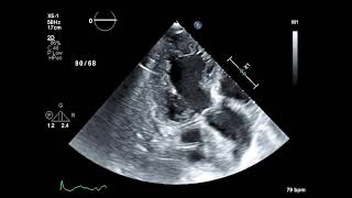 Hiding LV apical thrombus [upl. by Issej]