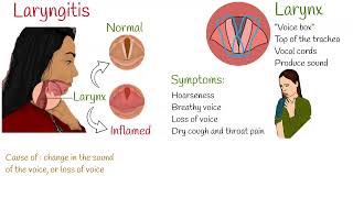 Laryngitis  Symptoms causes and treatment [upl. by Hanako]