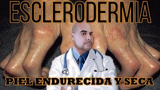 ESCLERODERMIA😑Resumen Total USMLE [upl. by Yesnek978]