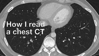 How I Read a Chest CT [upl. by Mayyahk]