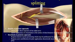 Humeral Shaft Fractures 2  Surgical techniques OTA lecture series III u04b [upl. by Labaw]