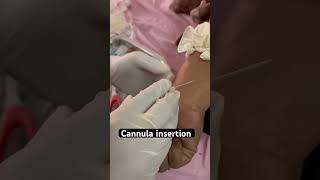 Cannula insertion 👍 shorts hospital cannula injection trending aiims doctor [upl. by Batory39]