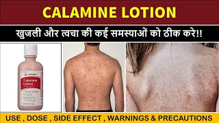 calamine lotion uses  खुजली के लिए बेस्ट लोशन  itching  scabies etc [upl. by Ellirehs]