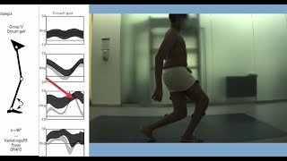 Gait Analysis Patterns in Diplegic Cerebral Palsy [upl. by Phil]