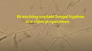 Branched Septate Fungal hyphae in Clinical Specimen [upl. by Somerset]