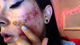 Severe cystic acne accutane week 1 [upl. by Ajssatan]