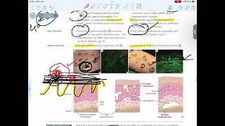 DERMATITIS HERPETIFORMISERYTHEMA MULTIFORMESTEVEN JOHNSON SYNDROME [upl. by Ahusoj]