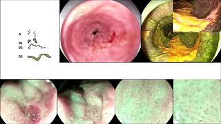 ESD for esophageal Squamous Carcinoma in a Patient with Achalasia [upl. by Lalad]