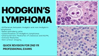 Hodgkin’s lymphoma pathology Quick revision for 2nd yr MBBS pathology examNEET PGNEXT [upl. by Mord469]