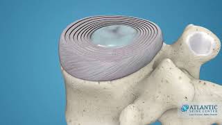 What is Cervical Disc Herniation AtlanticSpineCenter [upl. by Nydia]