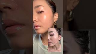 Before and after dark spot and mole removal [upl. by Analem]