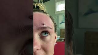 Cystic Acne Extractions Whiteheads  Blackheads Removal Today [upl. by Brunhild]