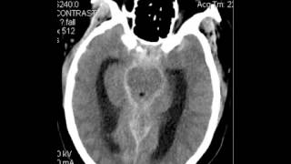 CT Head Subarachnoid Hemorrhage DISCUSSION by Radiologist [upl. by Thordia]