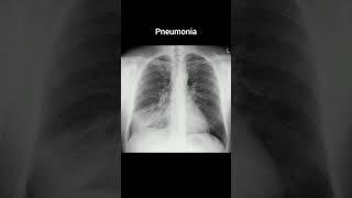 Pneumonia xray radiology röntgen anatomy chest pneumonia [upl. by Ameyn]