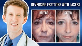 Laser Skin Resurfacing for Festoons with Dr Adam Scheiner [upl. by Wiseman]