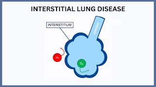 Interstitial Lung Disease Explained [upl. by Eelrehpotsirhc277]