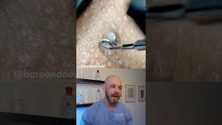 Gnarly ingrown hair removal dermreacts doctorreacts ingrownhair [upl. by Gayleen165]