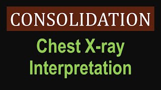 Lung Consolidation  Chest Xray Interpretation [upl. by Nage]