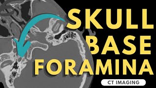 Osteology of the skull 5 inferior view [upl. by Remington137]