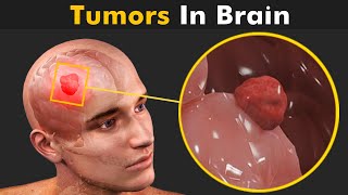 How Tumors Are Formed Inside The Brain  Glioma Brain Tumors 3D Animation [upl. by Ahsiemat]