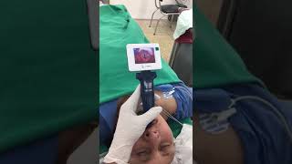 Video Laryngoscopy intubation for an Adult Patient [upl. by Ahouh]