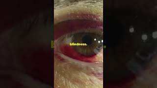 Understanding Trachoma Causes Symptoms 2024 10 22 [upl. by Tugman825]