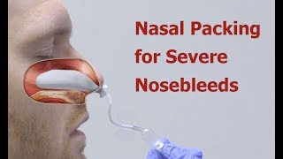 Nasal Packing for Severe Nosebleeds [upl. by Ackler226]