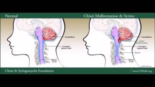 Chiari Malformation amp Syringomyelia [upl. by Anwaf336]