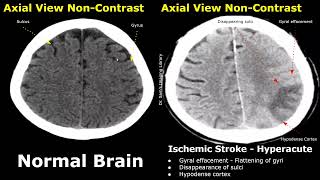 CT Scan Brain Normal Vs Ischemic Stroke Images  NonContrast HyperacuteAcuteChronic Infarction [upl. by Alecram]