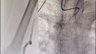 Brachial Loop With Right Subclavian Artery Tortuosity How To Get A Proper Angiogram [upl. by Adner]