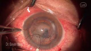 Phaco Xtreme Complex Cataract Surgery Case 3 [upl. by Melissa]