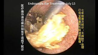 Re examination and cleaning of bilateral external auditory canal cholesteatoma after 7 years [upl. by Rohpotsirhc]