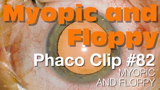 Phaco Clip 82  Myopic and Floppy [upl. by Nrevel134]