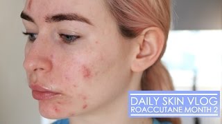 Roaccutane Daily Skin Vlog  Month 2 [upl. by Htebsil575]