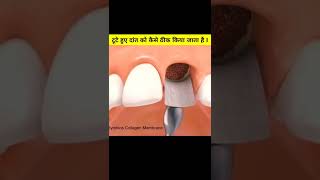 टूटे हुए दांत को कैसे ठीक किया जाता है brokenteeth​ short​ [upl. by Iatnohs]