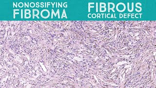 Nonossifying fibroma metaphyseal fibrous defectfibrous cortical defect bone pathology [upl. by Jamnes]