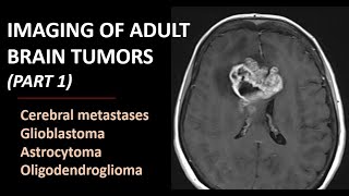 Imaging of brain tumors part 1 metastases glioblastoma and beyond [upl. by Llednor]